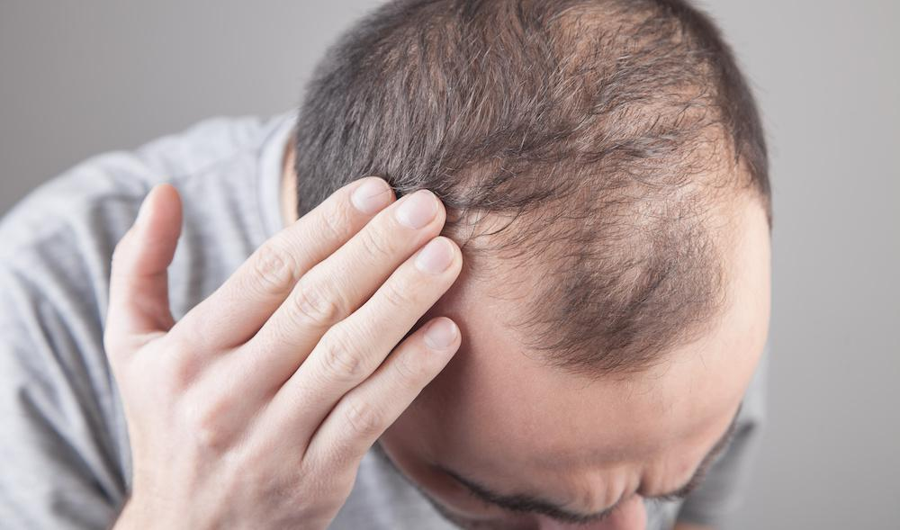 Breaking Down the Various Types of Alopecia: What You Need to Know